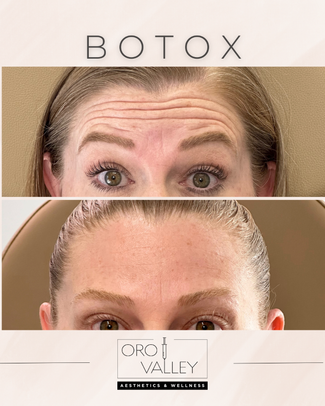 Botox before and after: forehead lines smoothed