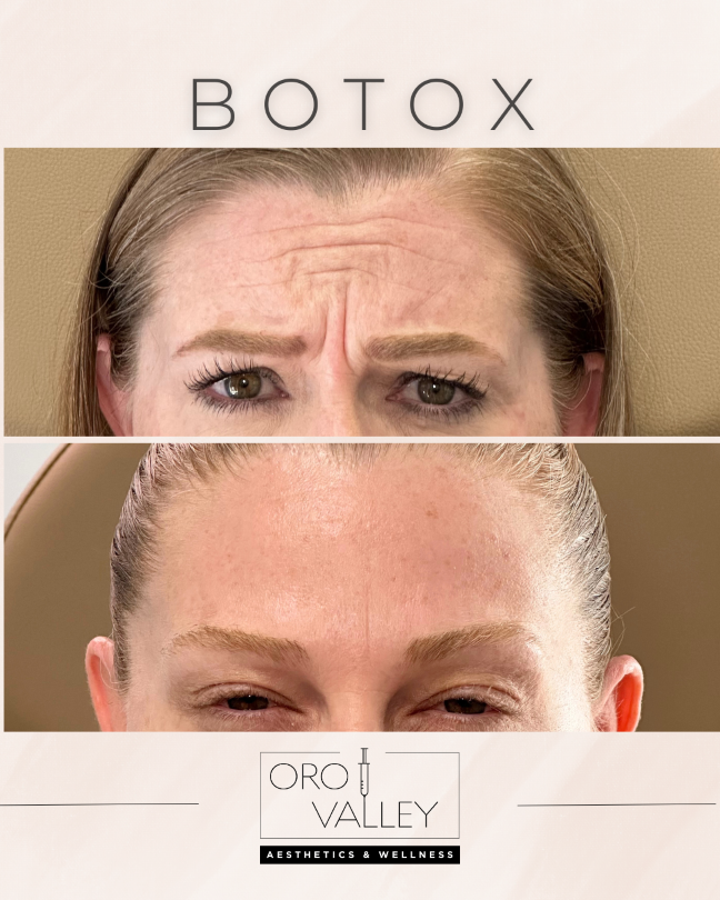 Botox before and after: frown lines between the brows smoothed